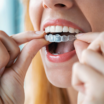 invisalign treatment